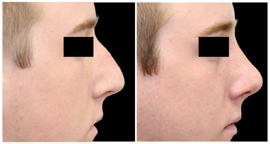 Side-by-side comparison of a male patient's profile before and after rhinoplasty surgery, showing changes in nasal shape.