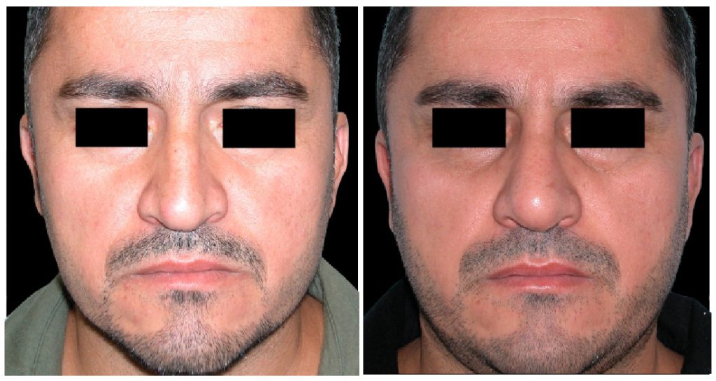 Before and after images of a male patient showing results of rhinoplasty, highlighting changes in nasal structure and facial symmetry.