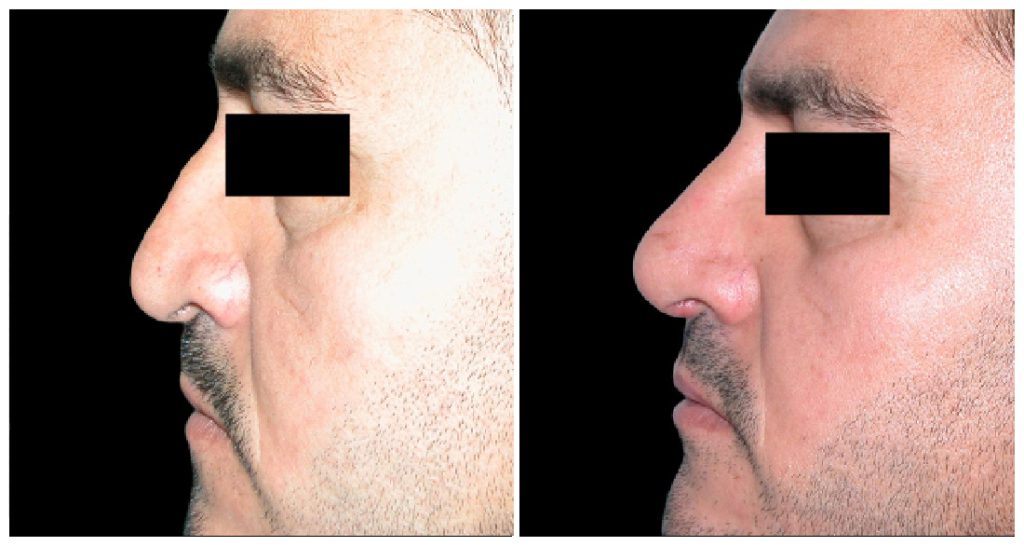 Before and after images of a lateral view of a male patient's nose following rhinoplasty surgery.