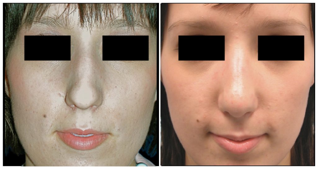 Before and after images of a rhinoplasty procedure showing changes in the nose shape and facial features.