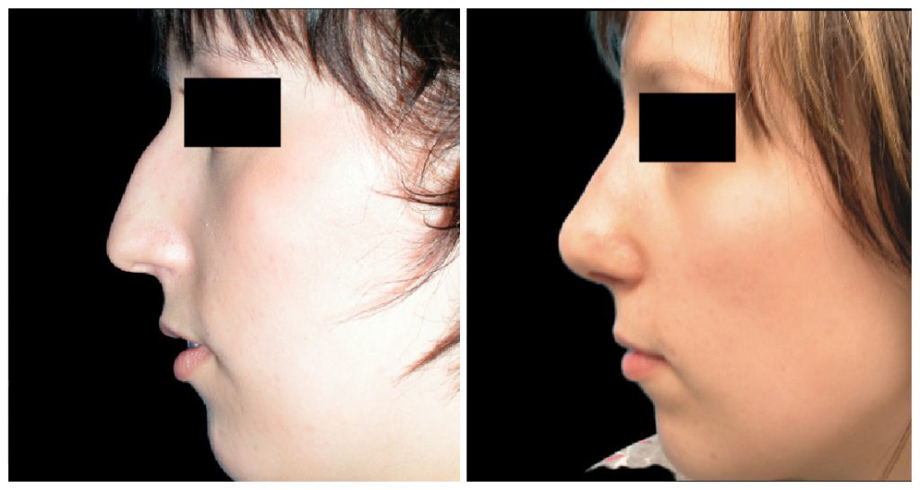 Before and after images of a rhinoplasty procedure showing profile views of a patient's nose.