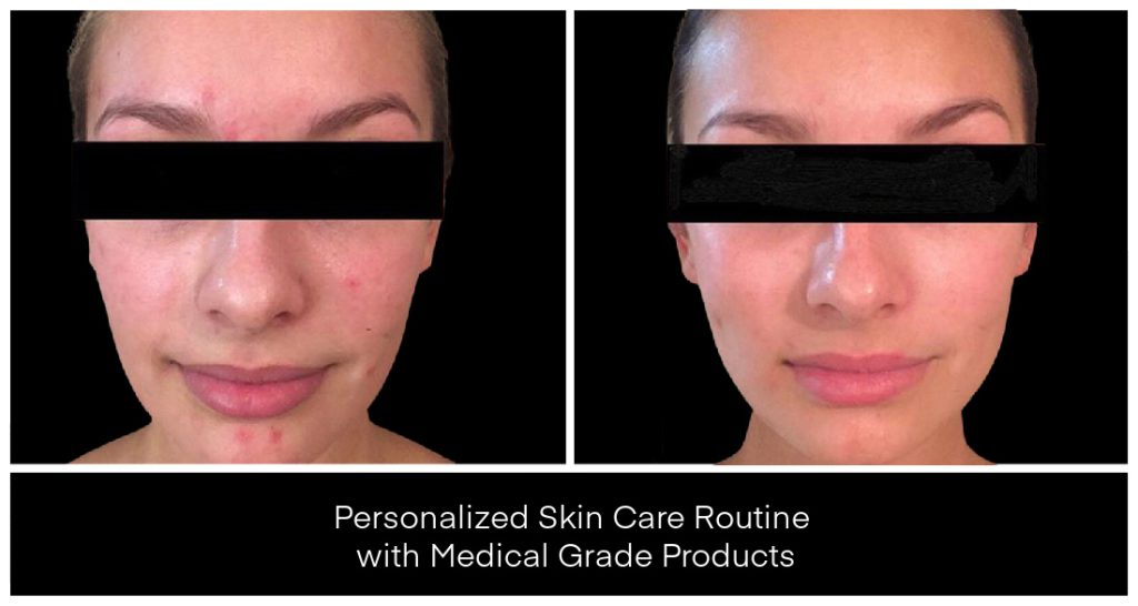 At-Home Skin Care before and after result