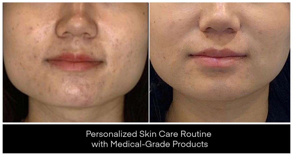 At-Home Skin Care before and after result