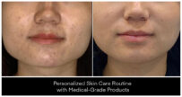 At-Home Skin Care before and after result
