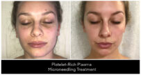 Microneedling London Ontario before and after result