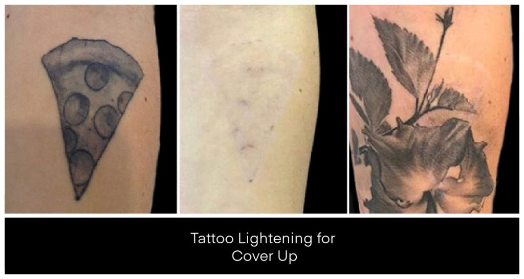 Laser Tattoo Removal in London Ontario before and after result