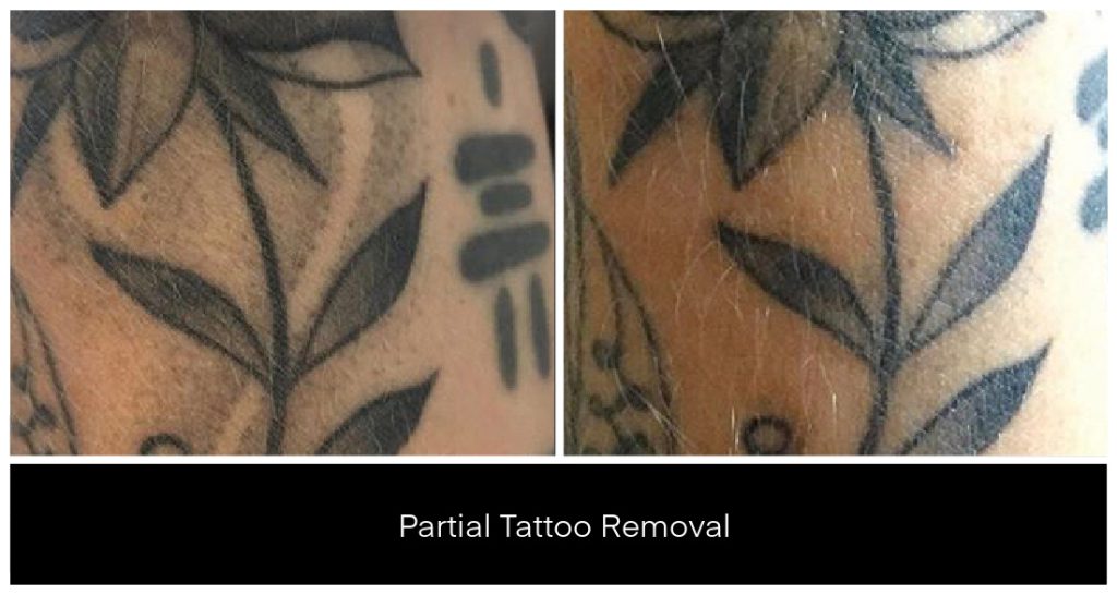 Laser Tattoo Removal in London Ontario before and after result