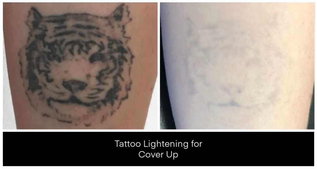 A tiger tattoo fades from dark ink to a lighter outline in a tattoo lightening for cover up treatment at Yazdani Aesthetics clinic in London Ontario.