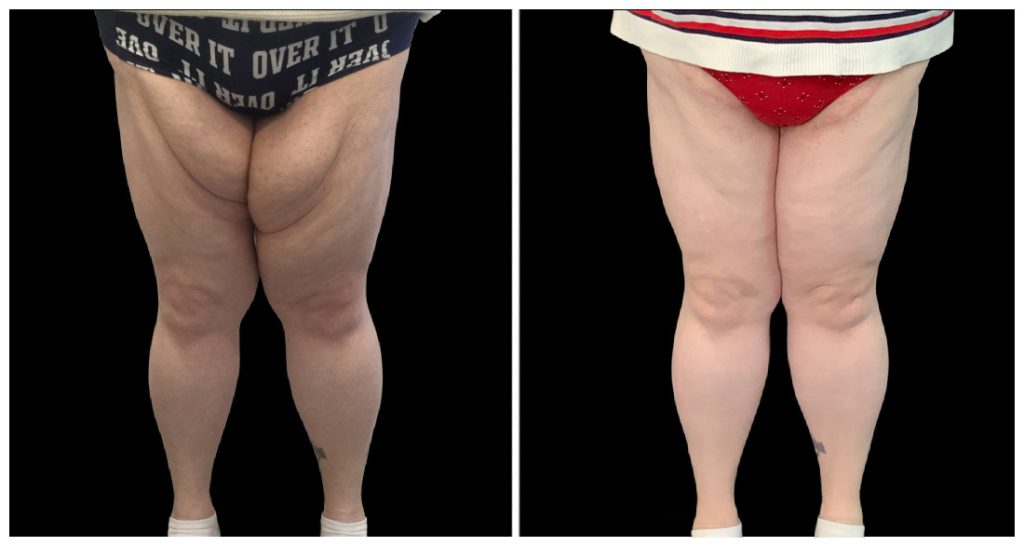 Before and after images of a thigh lift procedure, showing changes in skin appearance and contour of the thighs.