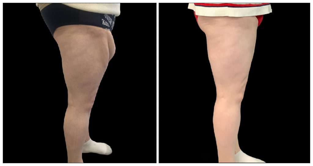 Thigh Lift in London Ontario before and after result
