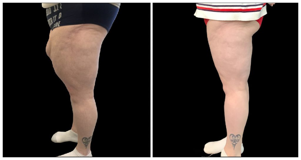 Side view of two legs showing differences in skin texture and contour, with visible tattoo on the ankle of the left leg.
