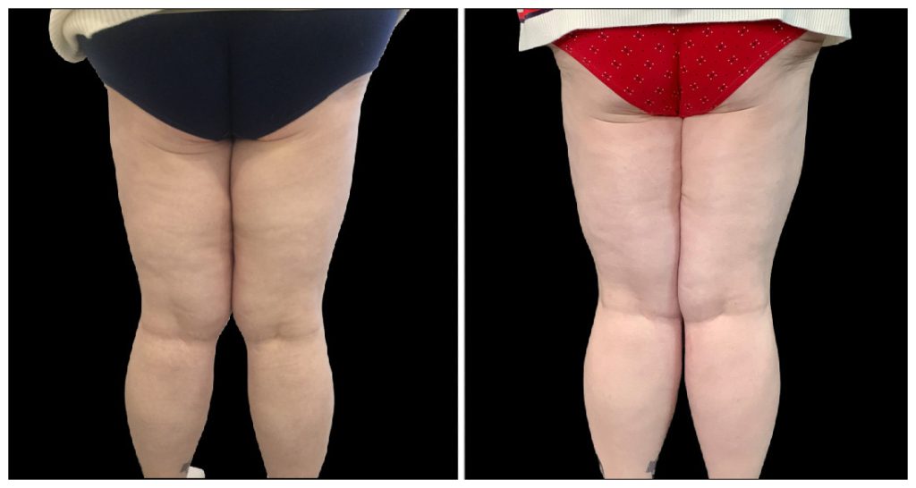 Thigh Lift in London Ontario before and after result