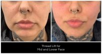 Yazdani Aesthetics Thread Lift image showing mid and lower face changes; features a facial tattoo on the neck and a septum piercing with clear skin texture and subtle redness around the cheeks