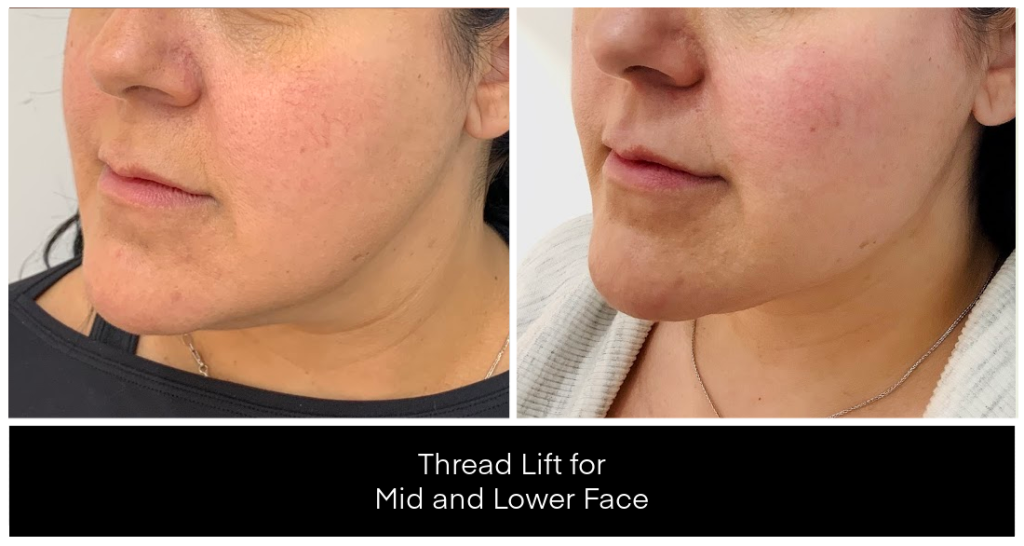 Thread lift for mid and lower face at Yazdani Aesthetics, showcasing improved jawline contour and smoother skin texture on a patient after treatment.