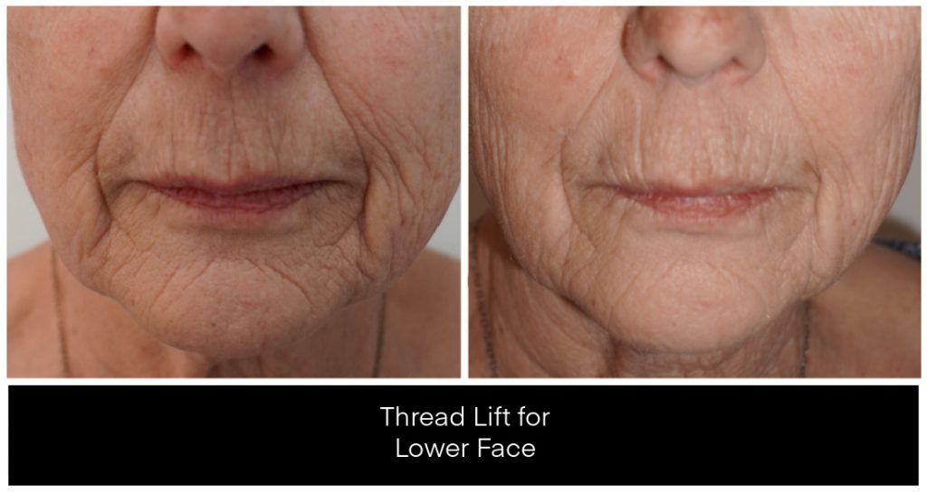 Yazdani Aesthetics Thread Lift for Lower Face collage showing two close-up views of the lower face with reduced wrinkles around the mouth and a firmer jawline.