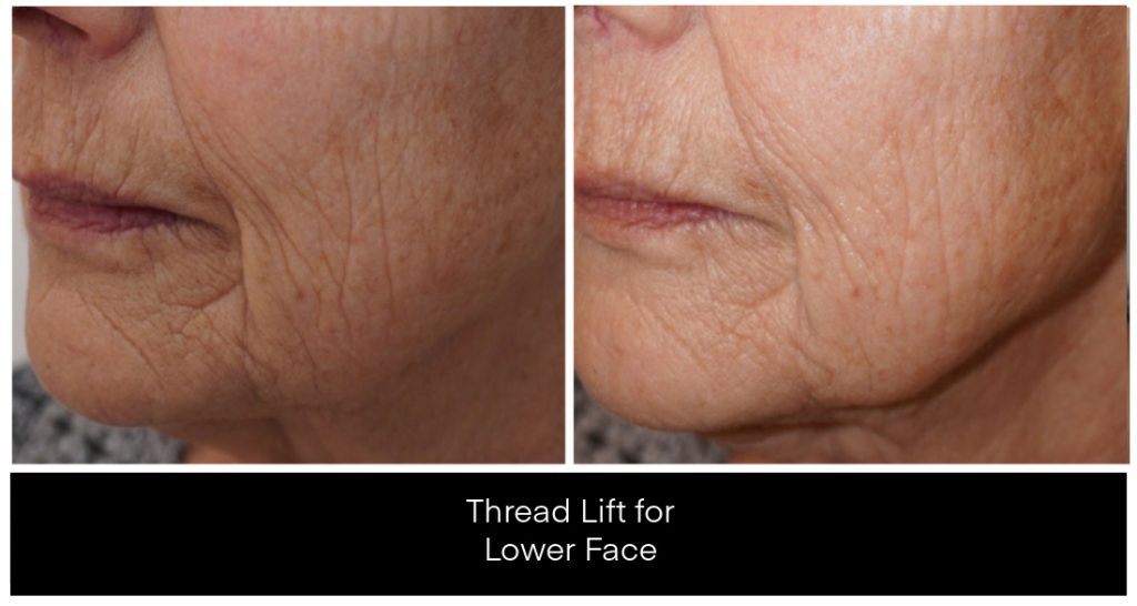 Yazdani Aesthetics Thread Lift for Lower Face close-up of a lower face with wrinkled, sun-kissed skin showing texture and lines, highlighting the treatment area