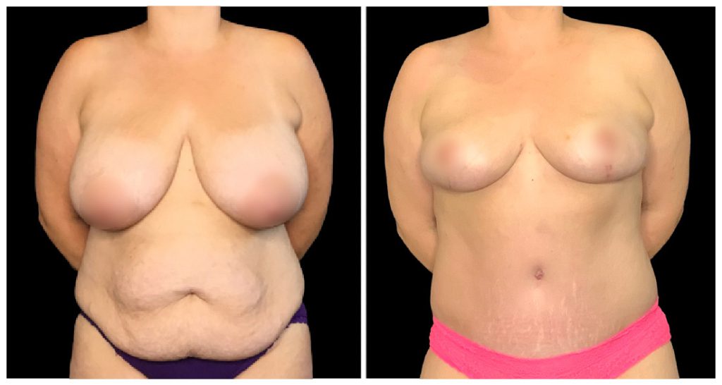 Tummy Tuck London Ontario before and after result