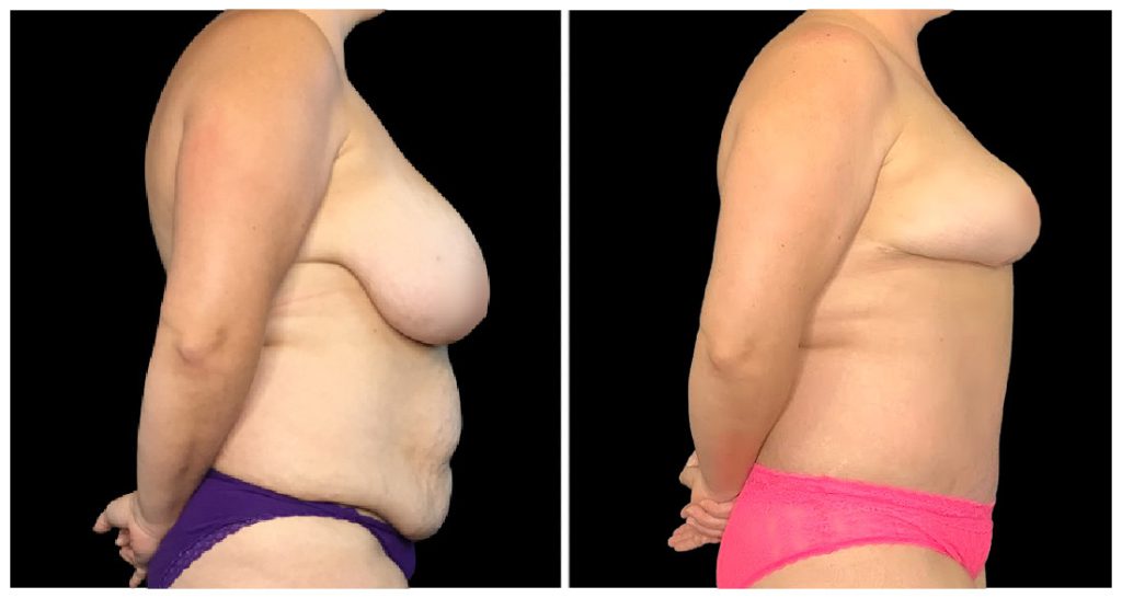 Tummy Tuck London Ontario before and after result