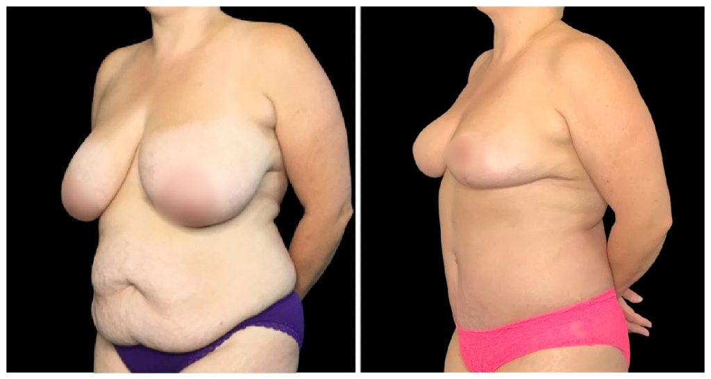 Tummy Tuck London Ontario before and after result