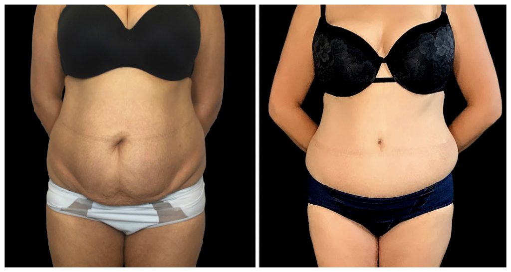 Tummy Tuck London Ontario before and after result