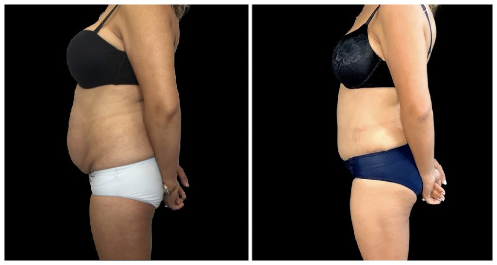 Tummy Tuck London Ontario before and after result