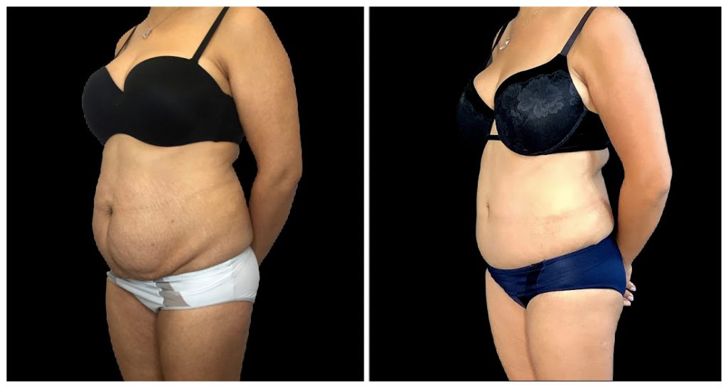 Tummy Tuck London Ontario before and after result