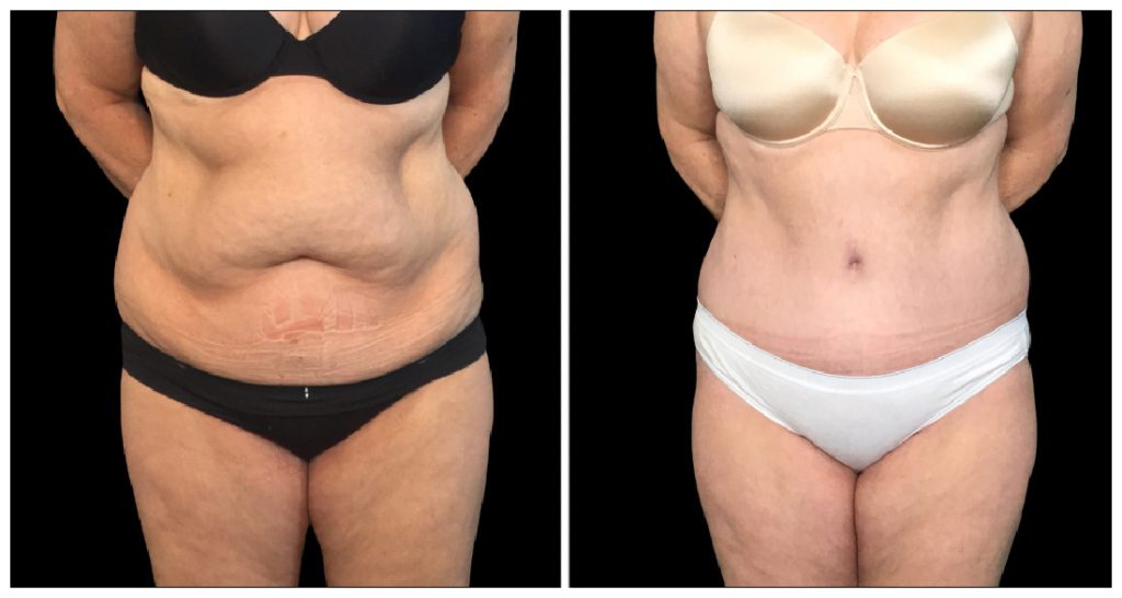 Tummy Tuck London Ontario before and after result