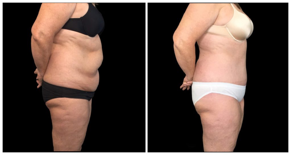 Tummy Tuck London Ontario before and after result