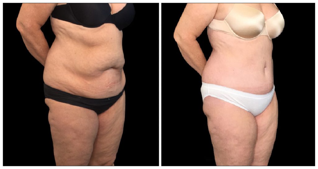 Tummy Tuck London Ontario before and after result