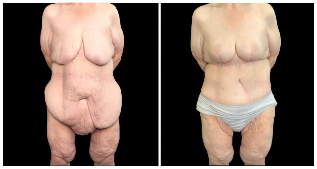 Tummy Tuck London Ontario before and after result