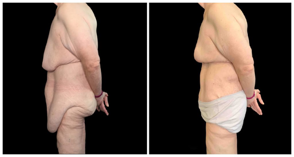 Tummy Tuck London Ontario before and after result