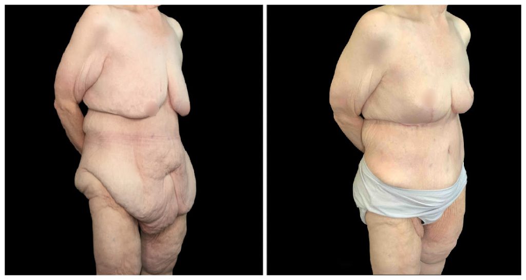 Tummy Tuck London Ontario before and after result