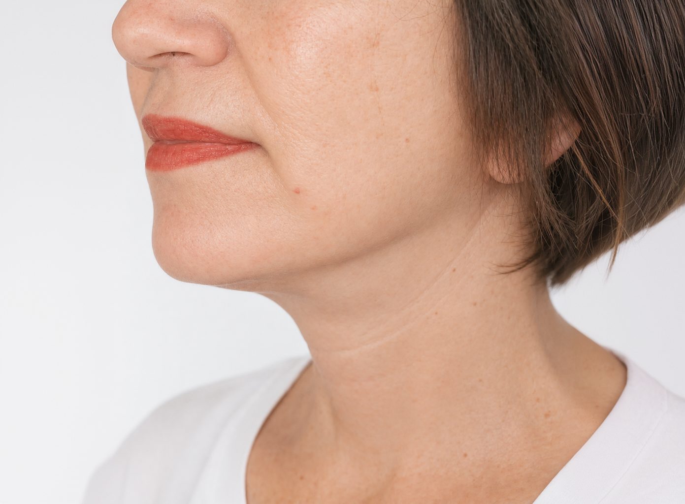 Patient after lower-face and neck treatment